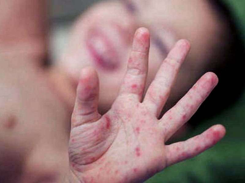 Ante aumento de casos en otros países, Chaco refuerza la prevención del sarampión Ante aumento de casos en otros países, Chaco refuerza la prevención del sarampión