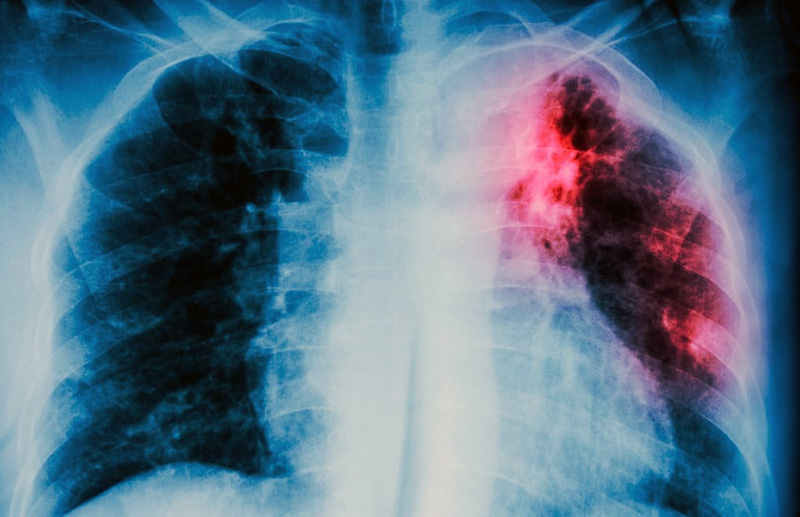 La tuberculosis aumenta más: los casos crecieron 71,6% desde 2020 y preocupa la mortalidad La tuberculosis aumenta más: los casos crecieron 71,6% desde 2020 y preocupa la mortalidad
